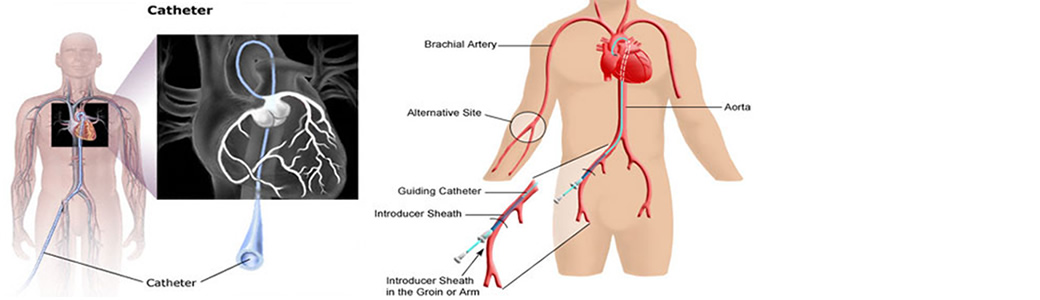 Cardiac Catheterization 
